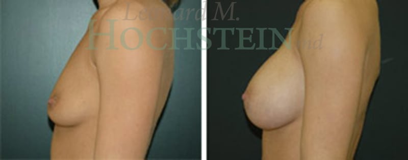 Breast Augmentation Patient