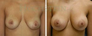Breast Augmentation Patient
