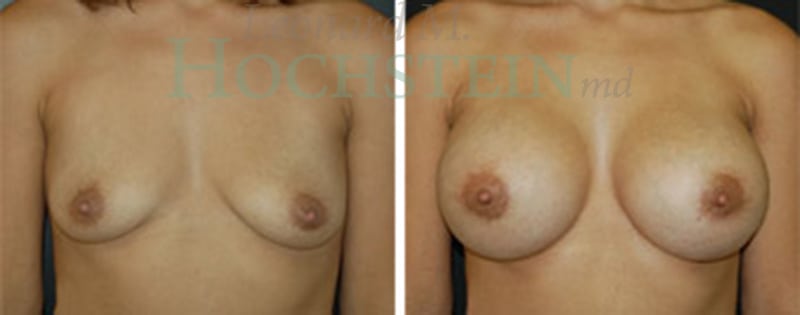 Breast Augmentation Patient