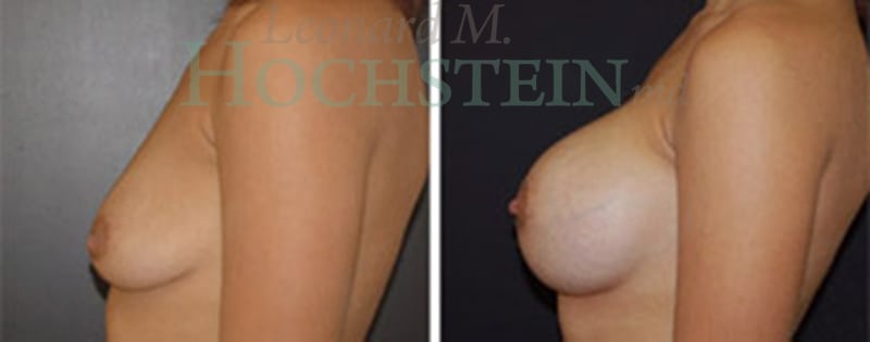 Breast Augmentation Patient