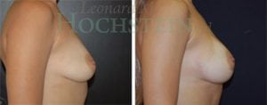 Breast Augmentation Patient