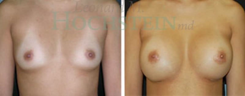 Breast Augmentation Patient