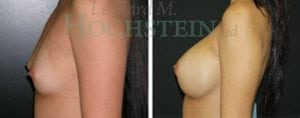 Breast Augmentation Patient