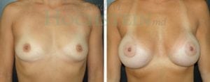 Breast Augmentation Patient