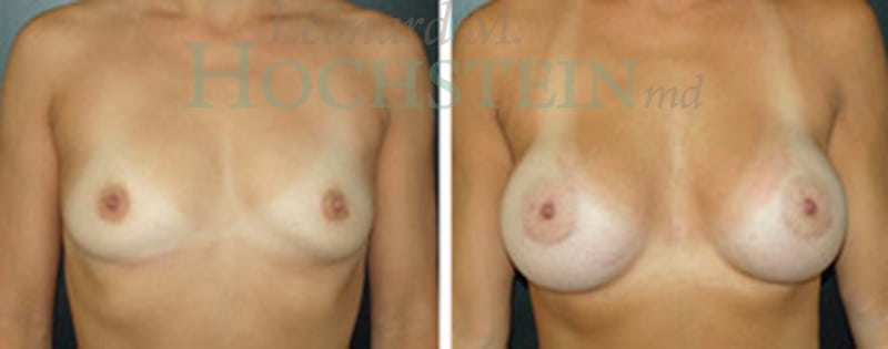 Breast Augmentation Patient