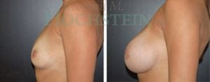 Breast Augmentation Patient