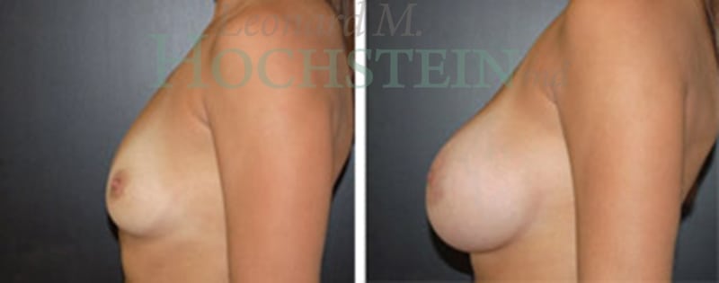 Breast Augmentation Patient