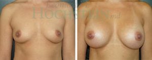 Breast Augmentation Patient