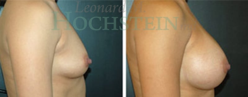 Breast Augmentation Patient