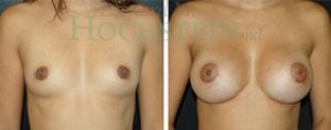Breast Augmentation Patient