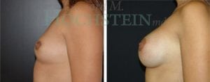 Breast Augmentation Patient
