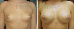 Breast Augmentation Patient