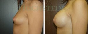 Breast Augmentation Patient