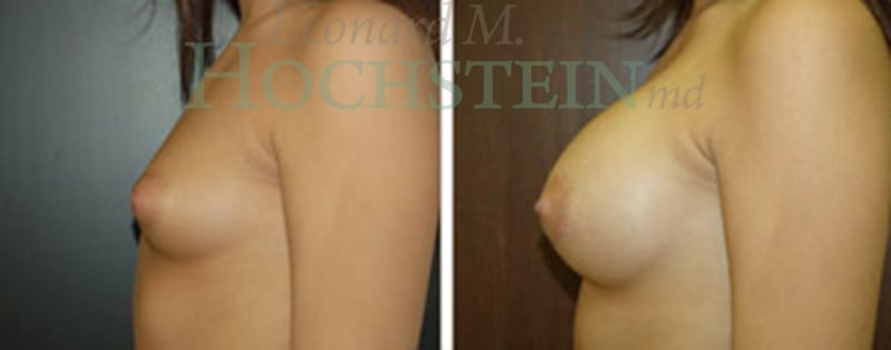 Breast Augmentation Patient