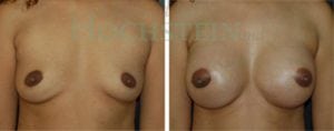 Breast Augmentation Patient