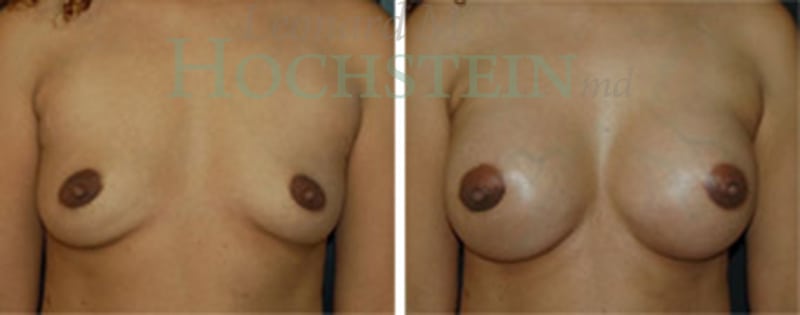 Breast Augmentation Patient