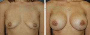Breast Augmentation Patient