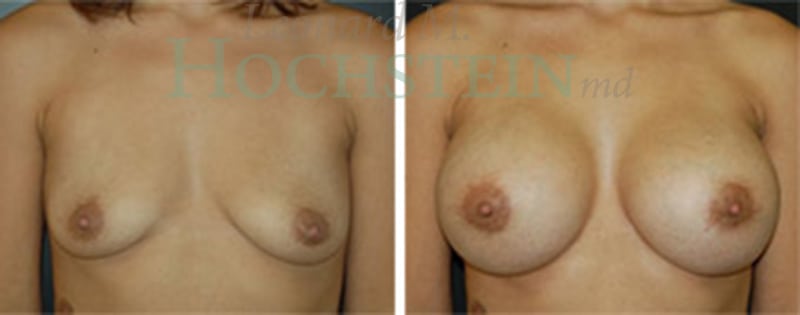 Breast Augmentation Patient
