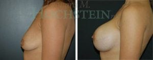 Breast Augmentation Patient