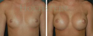 Breast Augmentation Patient