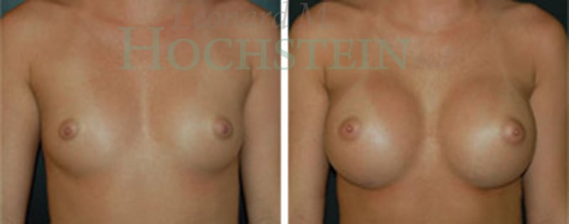 Breast Augmentation Patient