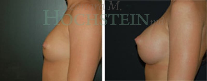 Breast Augmentation Patient