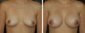 Breast Augmentation Patient