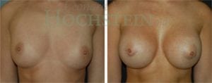 Breast Augmentation Patient