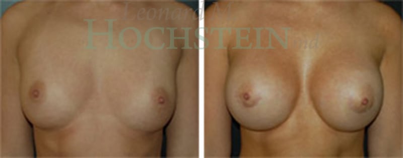 Breast Augmentation Patient