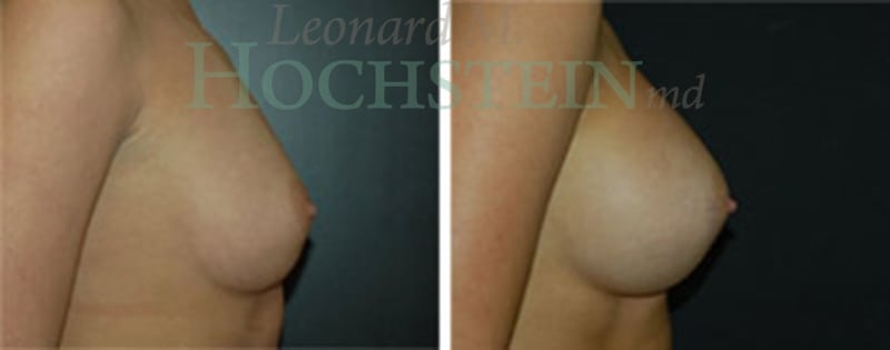 Breast Augmentation Patient