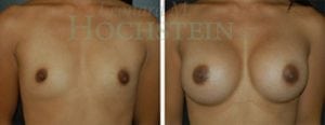 Breast Augmentation Patient