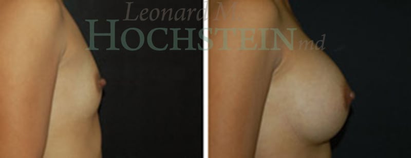 Breast Augmentation Patient