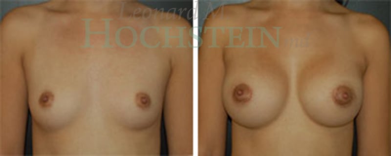 Breast Augmentation Patient