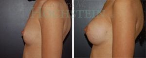 Breast Augmentation Patient