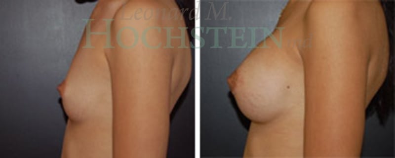 Breast Augmentation Patient