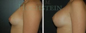 Breast Augmentation Patient