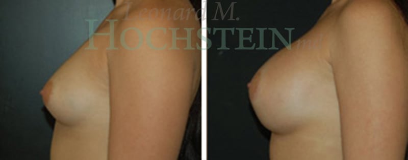 Breast Augmentation Patient