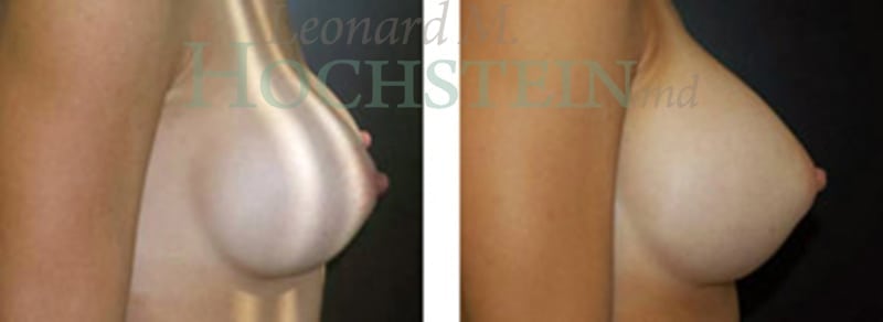 Breast Augmentation Patient