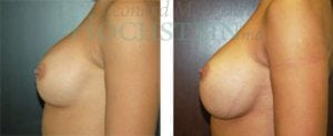 Breast Augmentation Patient