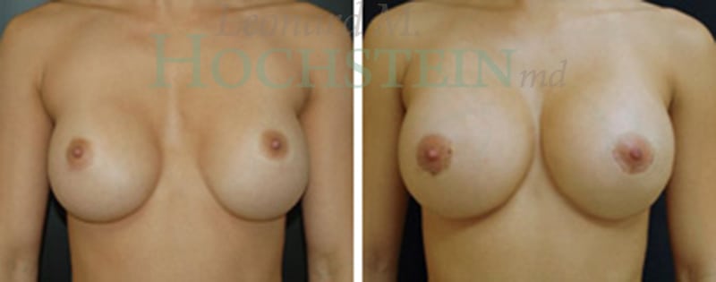 Breast Augmentation Patient