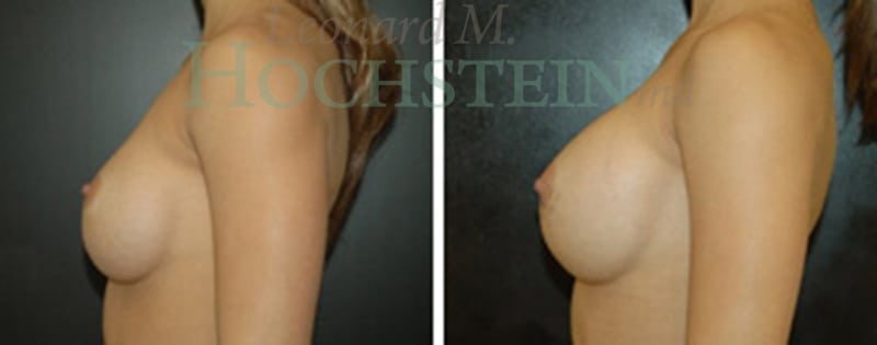 Breast Augmentation Patient