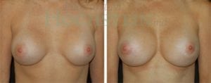Breast Augmentation Patient