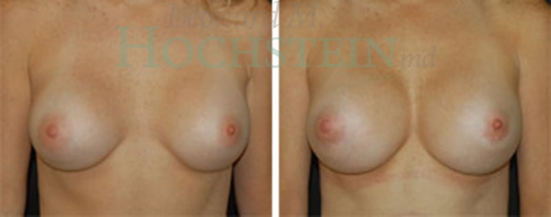 Breast Augmentation Patient