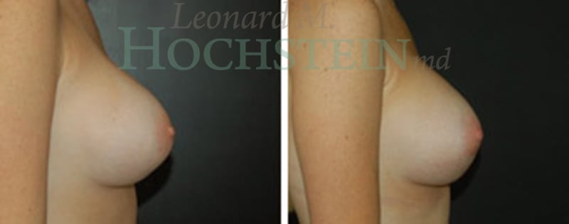 Breast Augmentation Patient