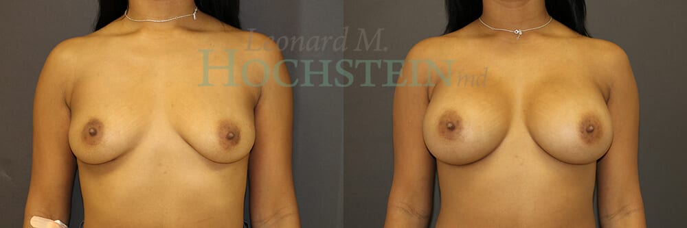 Breast Augmentation Patient