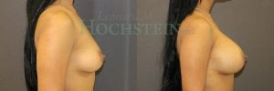 Breast Augmentation Patient