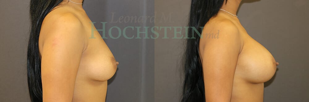 Breast Augmentation Patient