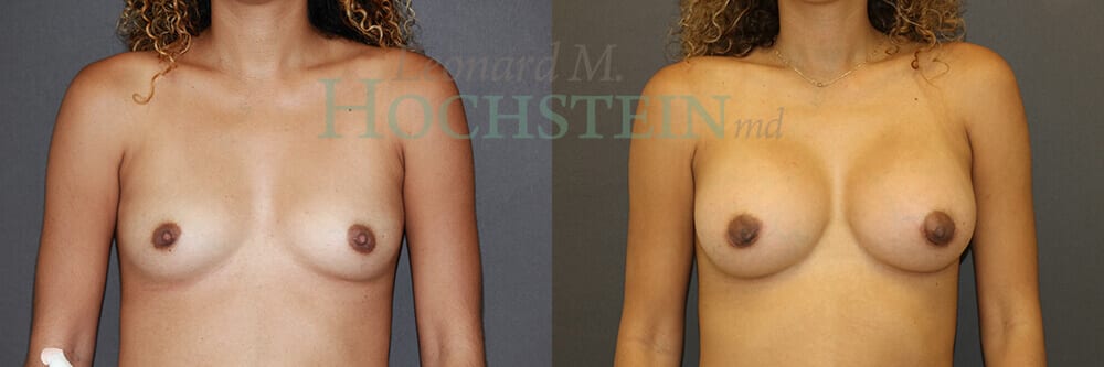 Breast Augmentation Patient