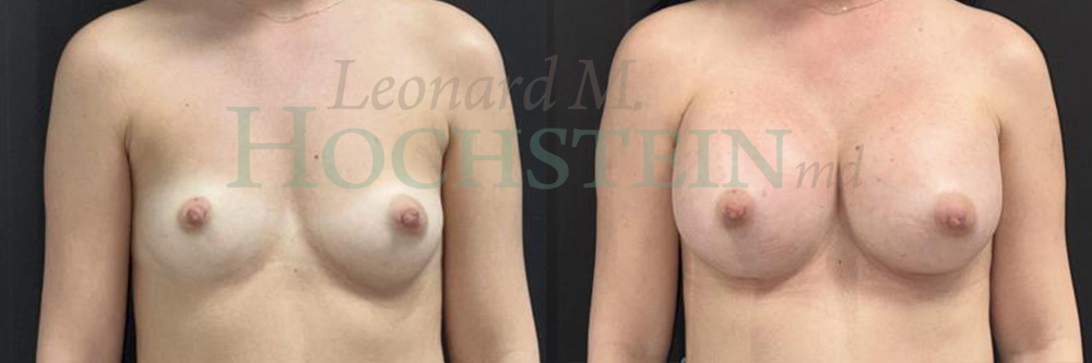 Breast Augmentation Patient