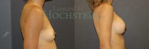 Breast Augmentation Patient